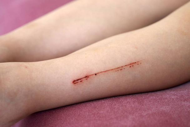 gamba ferita di un bambino, gamba graffiata e ferita di un bambino, - Foto, immagini