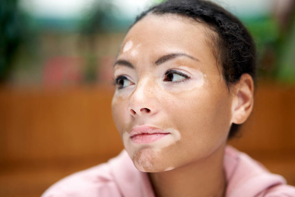 Black african american woman with vitiligo pigmentation skin problem indoor dressed pink hoodie close up portrait pensive black female thinking about - Foto, Imagem