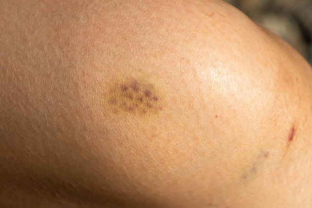 Antecedentes de la herida contusionada en la piel de la rodilla - Foto, Imagen