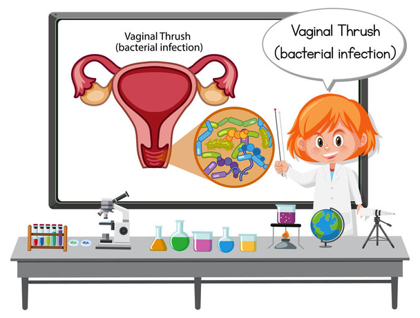 Junger Arzt erklärt Vaginaldrossel (bakterielle Infektion) Illustration - Vektor, Bild