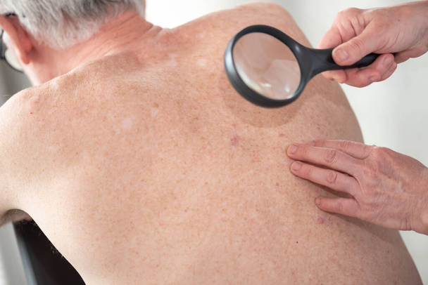 Dermatólogo examinando la piel de la espalda del paciente - Foto, Imagen
