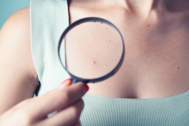 magnifying glass looks at a pimple on the body - Foto, Imagen