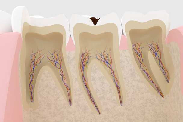 3D рендеринг поперечного сечения зуба с кариесом - Фото, изображение