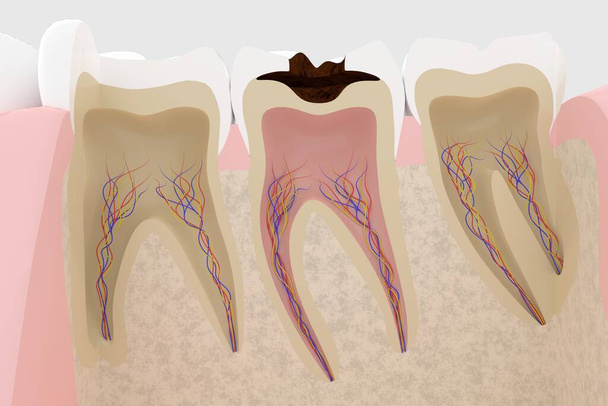 Representación en 3D de una sección transversal de un diente con caries - Foto, Imagen