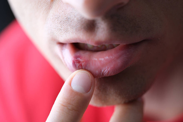 Herpès sur la lèvre interne mâle gros plan. Symptômes et traitement de l'herpès - Photo, image