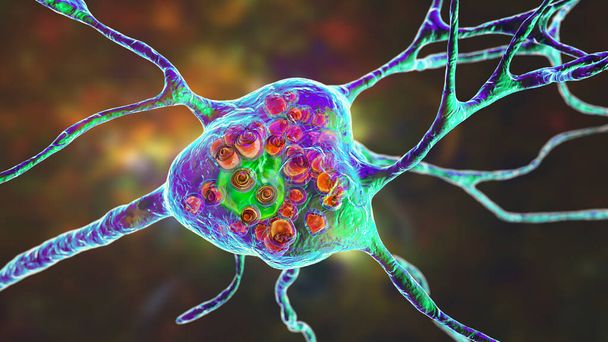 Tay-Sachs病の脳ニューロン、リソソーム内のガングリオシドの蓄積による膜性ラマーを含む腫脹した神経細胞を示す3Dイラスト - 写真・画像