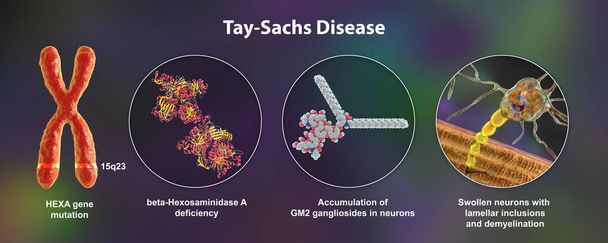 Tay-Sachs-Krankheit, 3D-Illustration. Eine genetische Störung, die Gehirnneuronen nach und nach zerstört, wird durch eine Mutation im HEXA-Gen des Chromosoms 15 verursacht, die zu einem Mangel der Hexosaminidase A führt. - Foto, Bild
