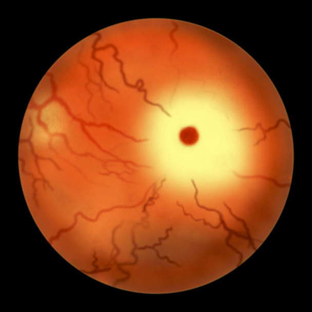 Retina ocular en la enfermedad de Tay-Sachs, ilustración 3D con la llamada mancha roja cereza. Un trastorno genético que destruye progresivamente las neuronas cerebrales, es causado por una mutación genética en el gen HEXA - Foto, Imagen