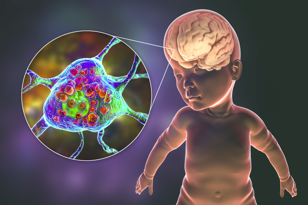 Tay-Sachs-Krankheit, eine lysosomale Speichergenetik, 3D-Illustration. Ein Kind mit Makrozephalie und Nahaufnahme geschwollener Neuronen mit lamellären Einschlüssen aufgrund von Gangliosiden - Foto, Bild