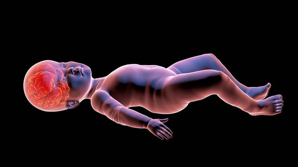 Ребенок с макроцефалией, увеличенным мозгом, гипотонией, умственной и двигательной задержкой, 3D иллюстрацией. Патологическая макроцефалия с мегаэнцефалией, генетические нарушения - Фото, изображение