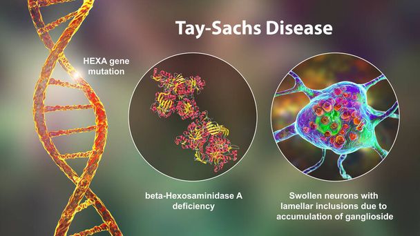 Malattia di Tay-Sachs, illustrazione 3D. Un disturbo genetico che distrugge progressivamente i neuroni cerebrali, è causato da una mutazione genetica nel gene HEXA che porta alla carenza di enzima esosaminidasi A - Foto, immagini
