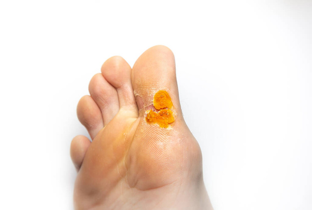 Contagious skin illness on foot. Medical treatment photo - Photo, Image
