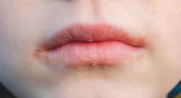 Cheilitis on the lips. Inflamed lips.Skin diseases and dermatology - Photo, Image
