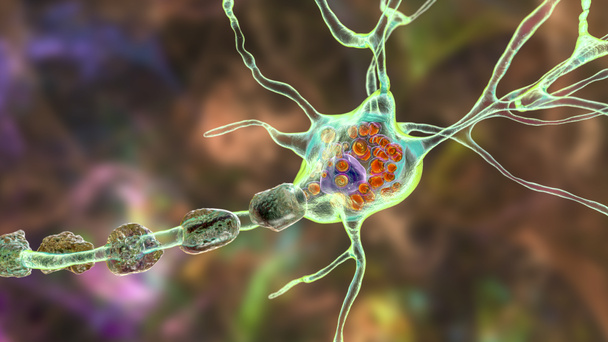 Gehirnneuronen bei lysosomalen Speichererkrankungen, Tay-Sachs, Niemann-Pick, Fabry und anderen. 3D-Illustration zeigt geschwollene Neuronen mit lamellären Einschlüssen aufgrund der Akkumulation von Gangliosiden in Lysosomen - Foto, Bild