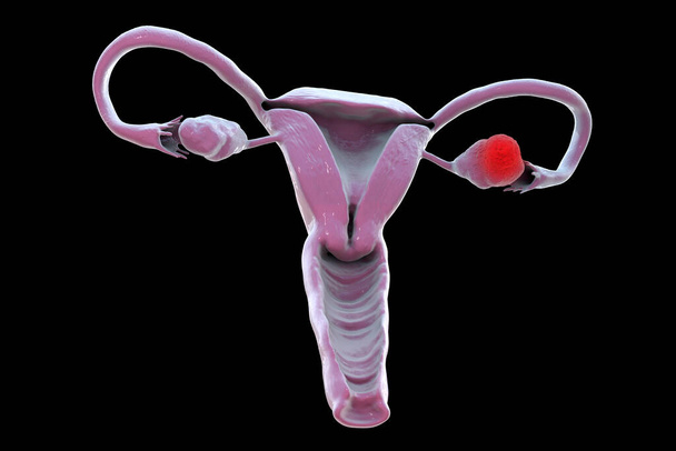 Cancer de l'ovaire, illustration 3D montrant une tumeur maligne dans l'ovaire gauche - Photo, image