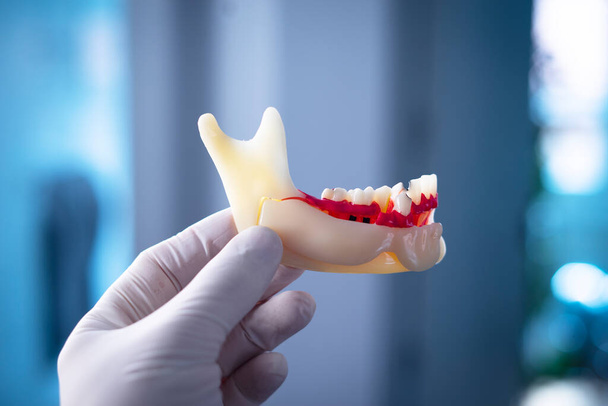 Fogszuvasodás fogorvosok fogászati modell fogak, íny és gyökérkezelés - Fotó, kép