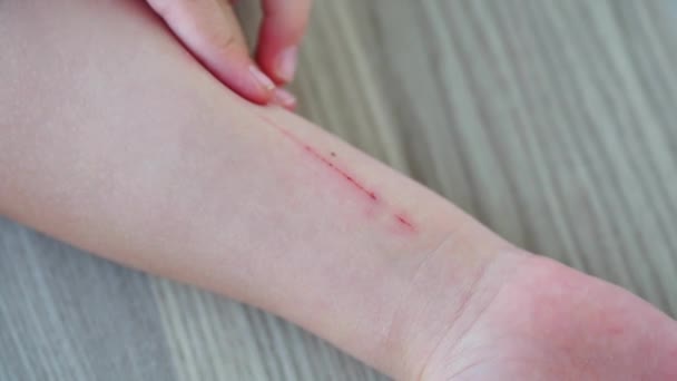 a child's scratched and injured arm,arm injuries, - Footage, Video