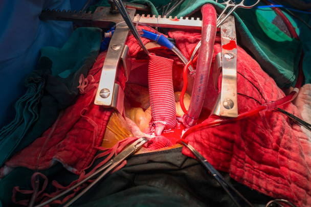 Réimplantation coronarienne dans l'anévrisme aortique ascendant
 - Photo, image
