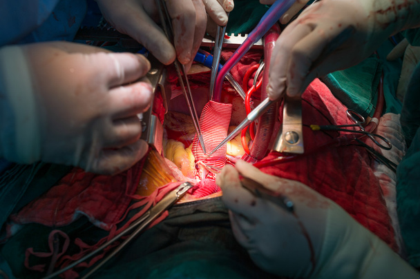 koronární re implantace v vzestupné aorty - Fotografie, Obrázek