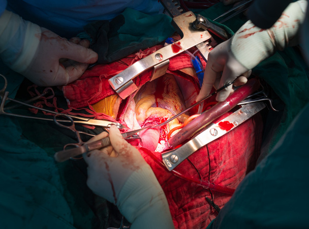 szívkoszorúér-re implantáció növekvő aorta aneurizma - Fotó, kép