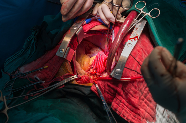 昇順大動脈瘤で bentall の操作 - 写真・画像