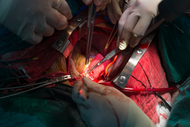 je Bentallova operace v vzestupné aorty - Fotografie, Obrázek