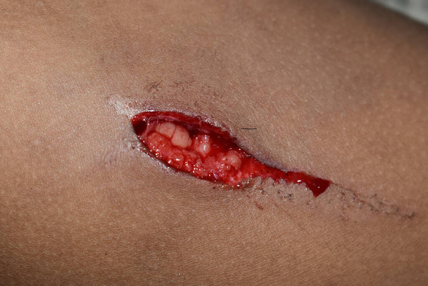 Herida lacerada con leve sangrado. Lesión traumática en el muslo de un niño asiático. - Foto, Imagen