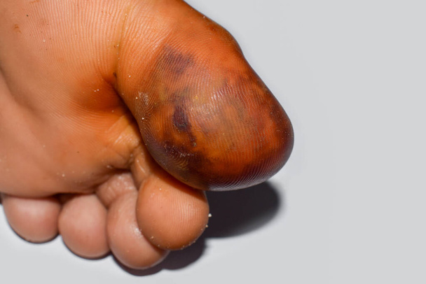 Ropień z otaczającym zapaleniem tkanki łącznej lub gronkowcem, zakażenie skóry paciorkowcem u dużego palca azjatyckiego birmańskiego pacjenta płci męskiej. - Zdjęcie, obraz