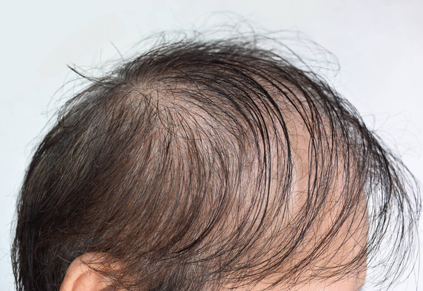 Cienkie lub rzadkie włosy, męski wzór wypadania włosów w Azji Południowo-Wschodniej, chiński starszy mężczyzna. - Zdjęcie, obraz