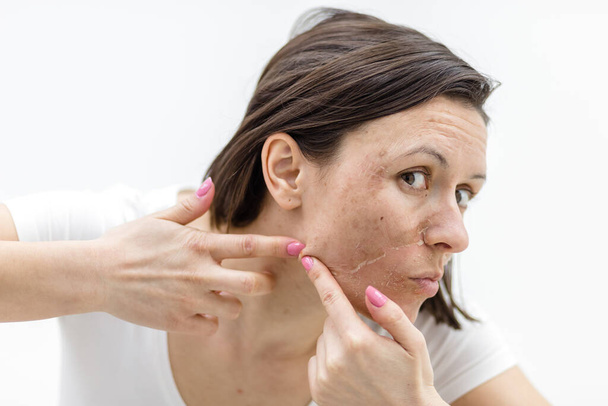 Photo of woman with acne problem squeezing pimple indoors. - 写真・画像