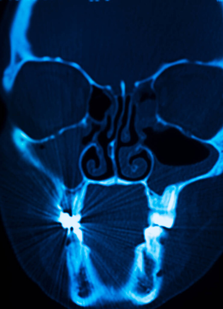 Röntgenbild Schädel Nase medizinische Untersuchung Ergebnisse aus Klinik. - Foto, Bild