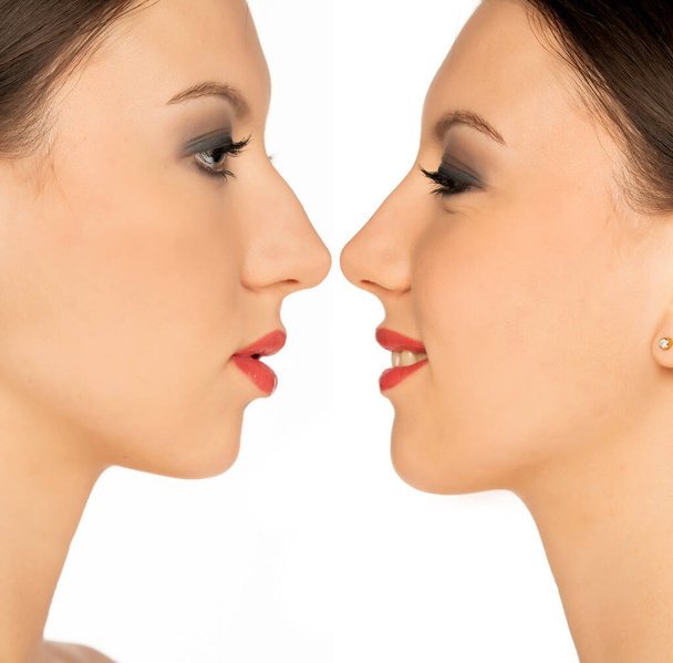 összehasonlítás portré egy fiatal nő, előtt és után plasztikai műtét az orr fehér alapon - Fotó, kép