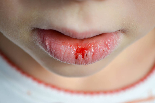Dry and damaged lips of a girl. Close-up. Lip fissure and bleeding. Sick cracked damaged tissue. Dry lips with cracks, dry mouth, Closeup face with brittle and dry lips, dehydration High quality photo - Photo, Image