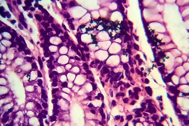 Disentería bacilar, micrografía ligera, foto bajo microscopio que muestra la presencia de bacterias y la acumulación de células inflamatorias en el epitelio intestinal - Foto, imagen