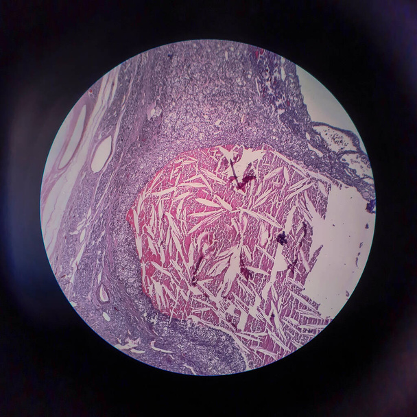 Schildklier folliculair carcinoom, licht micrograaf, foto onder microscoop - Foto, afbeelding