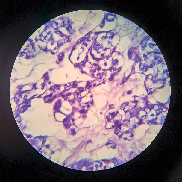 Pajzsmirigy follikuláris karcinóma, fénymikrográf, fénykép mikroszkóp alatt - Fotó, kép