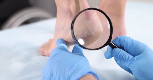 Podiatrist doctor examining cracks in patient heels with magnifying glass 4k movie - Footage, Video