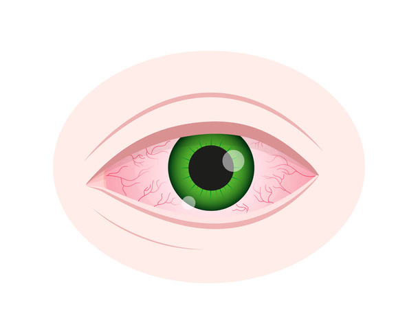 Irritación ocular. Ojo inyectado en sangre con conjuntiva roja aislada sobre fondo blanco. Síntoma de queratitis, alergia, conjuntivitis. Dibujos animados vectoriales ilustración - Vector, imagen