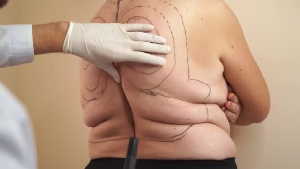 Markup spine of fat woman for liposuction surgery. Kyphosis. Surgigal removal of widow hump. - Footage, Video