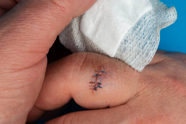 Postoperatieve hechtingen aan de vinger van de hand steken op de gewonde vinger. Foto genomen onder kunstlicht - Foto, afbeelding