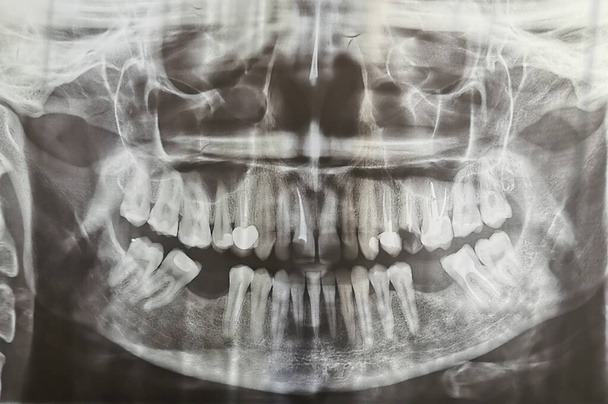 Стоматологічна рентгенографія. Цифрове рентгенівське сканування зубів дорослої жінки. Людські зуби рентгенівський вигляд спереду
 - Фото, зображення
