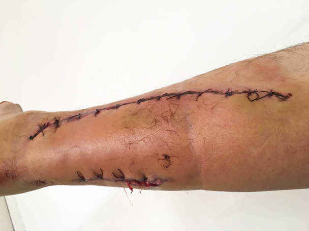 taglio profondo sulla gamba ferita suturata con una sutura chirurgica per la medicina - Foto, immagini