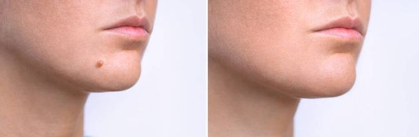 Женское лицо до и после удаления родинки. Лазерное лечение при удалении родимого пятна с лица пациента. - Фото, изображение