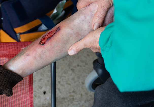 herida convertida en úlcera varicosa en una pierna que debe ser sanada diariamente - Foto, imagen
