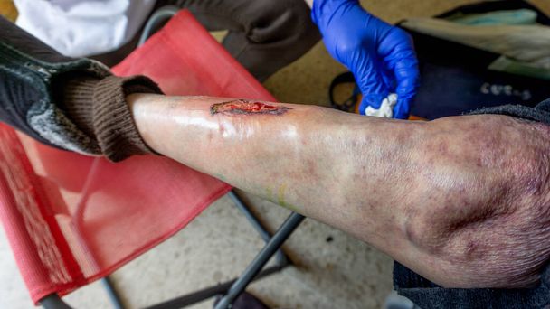 ferita trasformata in ulcera varicosa su una gamba che deve essere guarita quotidianamente - Foto, immagini