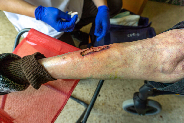 рана перетворилася на виразкову хворобу на нозі, яку необхідно лікувати щодня
 - Фото, зображення