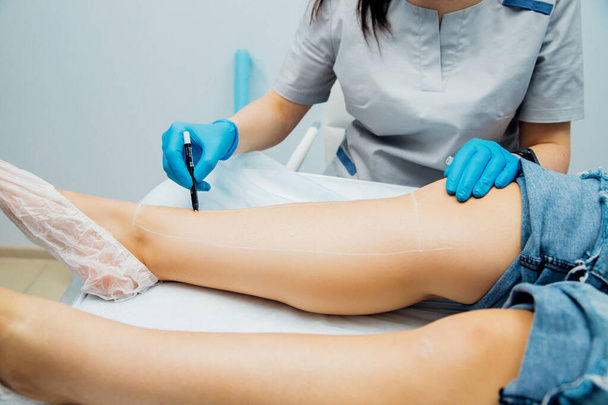 Women's hands in blue gloves mark the area for epilation and protection of moles with a pencil. Skin care. Laser hair removal of female legs. - Фото, зображення