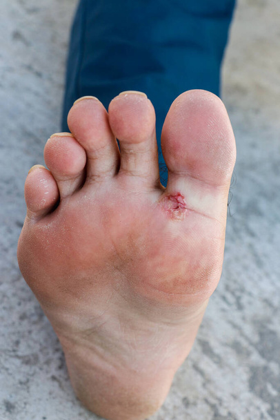 Нога спортсмена - опоясывающий педикюр, грибковая инфекция или подошва ног с дерматитом, субъект мягкий фокус - Фото, изображение