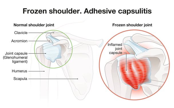 Zmrzlé rameno. Operace adhezivní kapsle. Popisovaná ilustrace - Fotografie, Obrázek