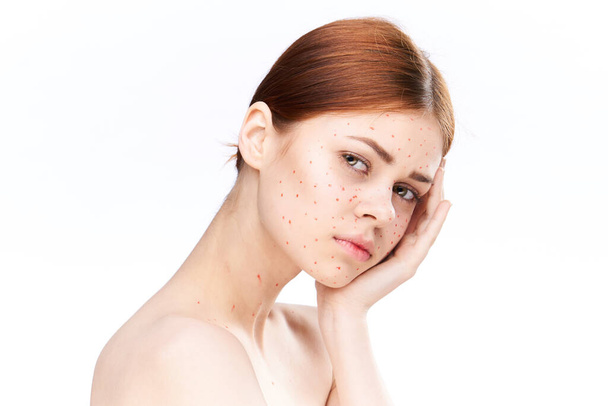 sad woman with bare shoulders red dots on her face - Foto, afbeelding